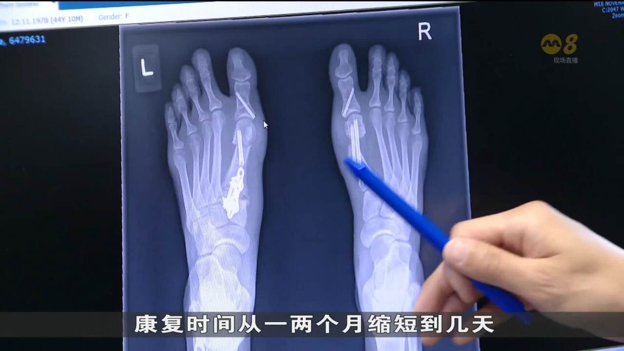 先进微创手术治疗拇囊炎复原更快伤疤更小- 8world